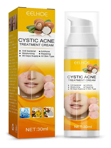 EELHOE Cystic Acne Treatment Cream | كريم للعناية بالبشرة المعرضة للحبوب