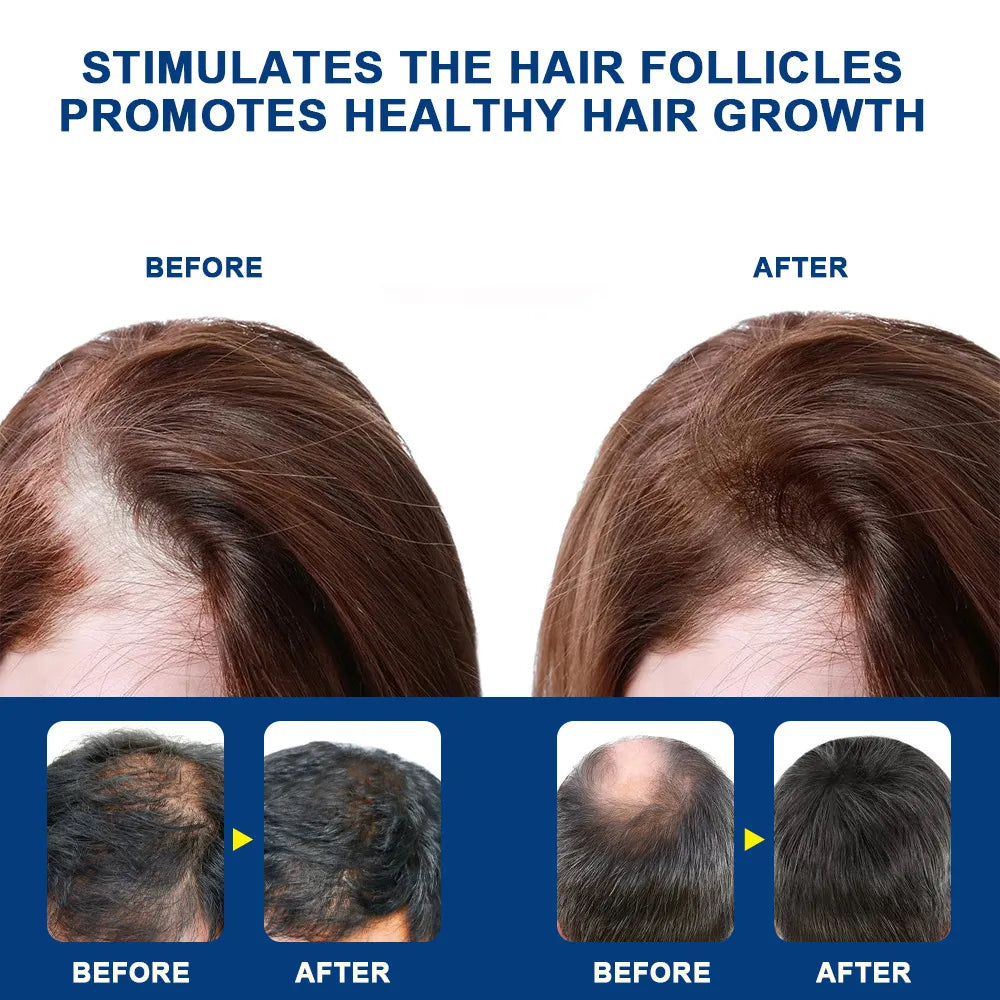 Sumifun Alopecia Hair Growth Cream | كريم العناية بالشعر وتحسين مظهر الكثافة